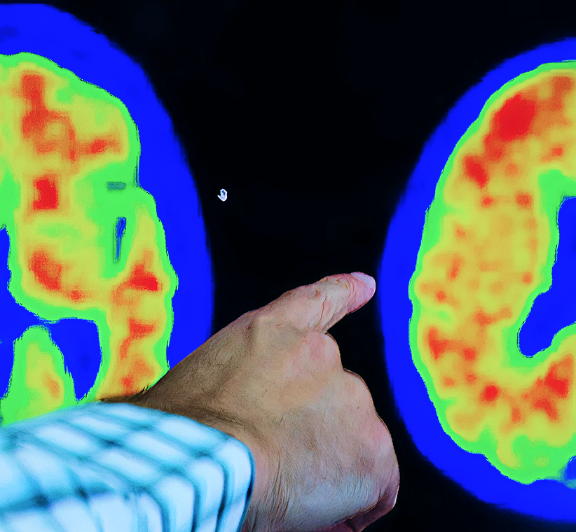 High blood pressure and Alzheimer’s disease could go hand in hand, study finds